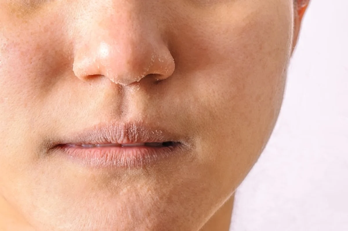 dry skin close up woman face winter